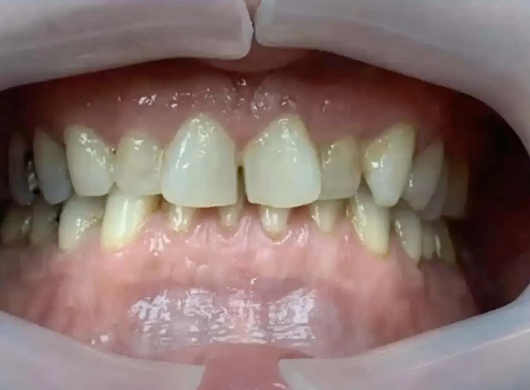 Precise Invisalign enamel reduction with Swiss quality